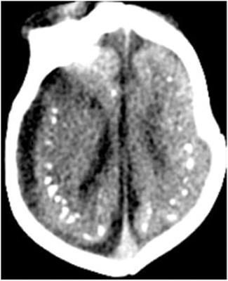 Nervous System Injury and Neuroimaging of Zika Virus Infection